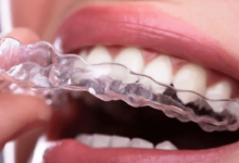 Orthodontic Services for Straightening Teeth and Smiles